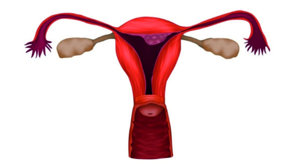 All you need to know about Uterine Fibroids