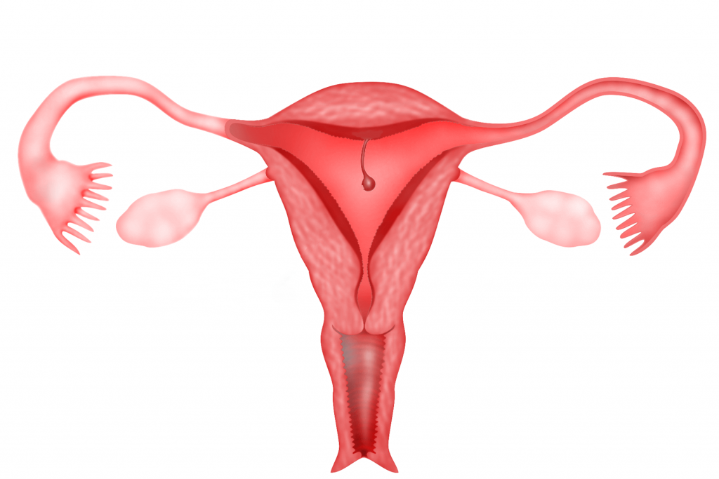 Uterine Polyps Symptoms and Causes